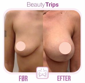 brystoperation før/efter